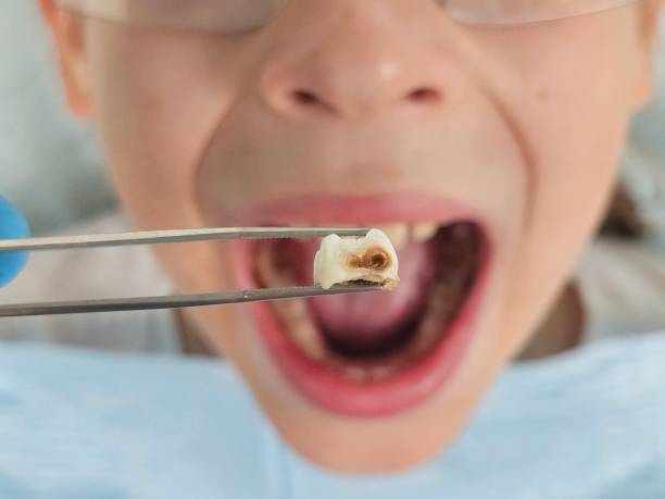Best Emergency Tooth Extraction in West Pensacola, FL